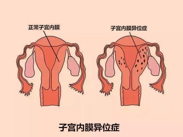 子宫内膜异位症