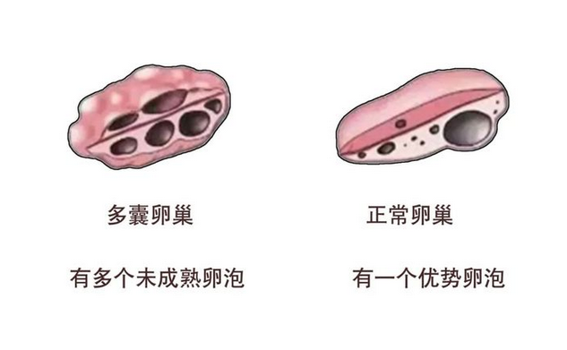 多囊卵巢